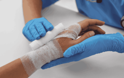 ¿Qué hacer en caso de quemaduras?